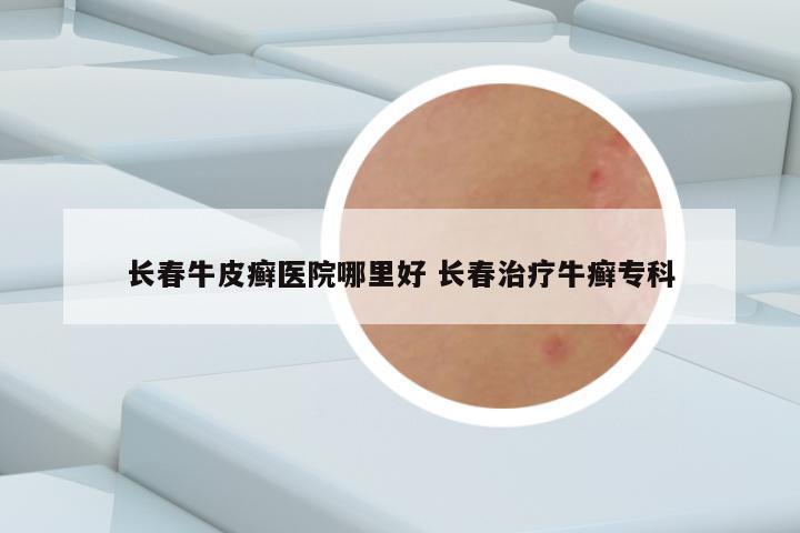 长春皮肤病医院